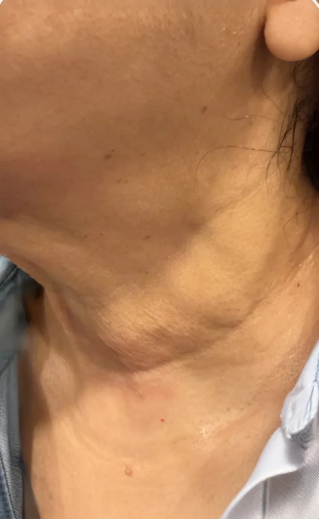 Fotona Neck Lifting Result before treatment