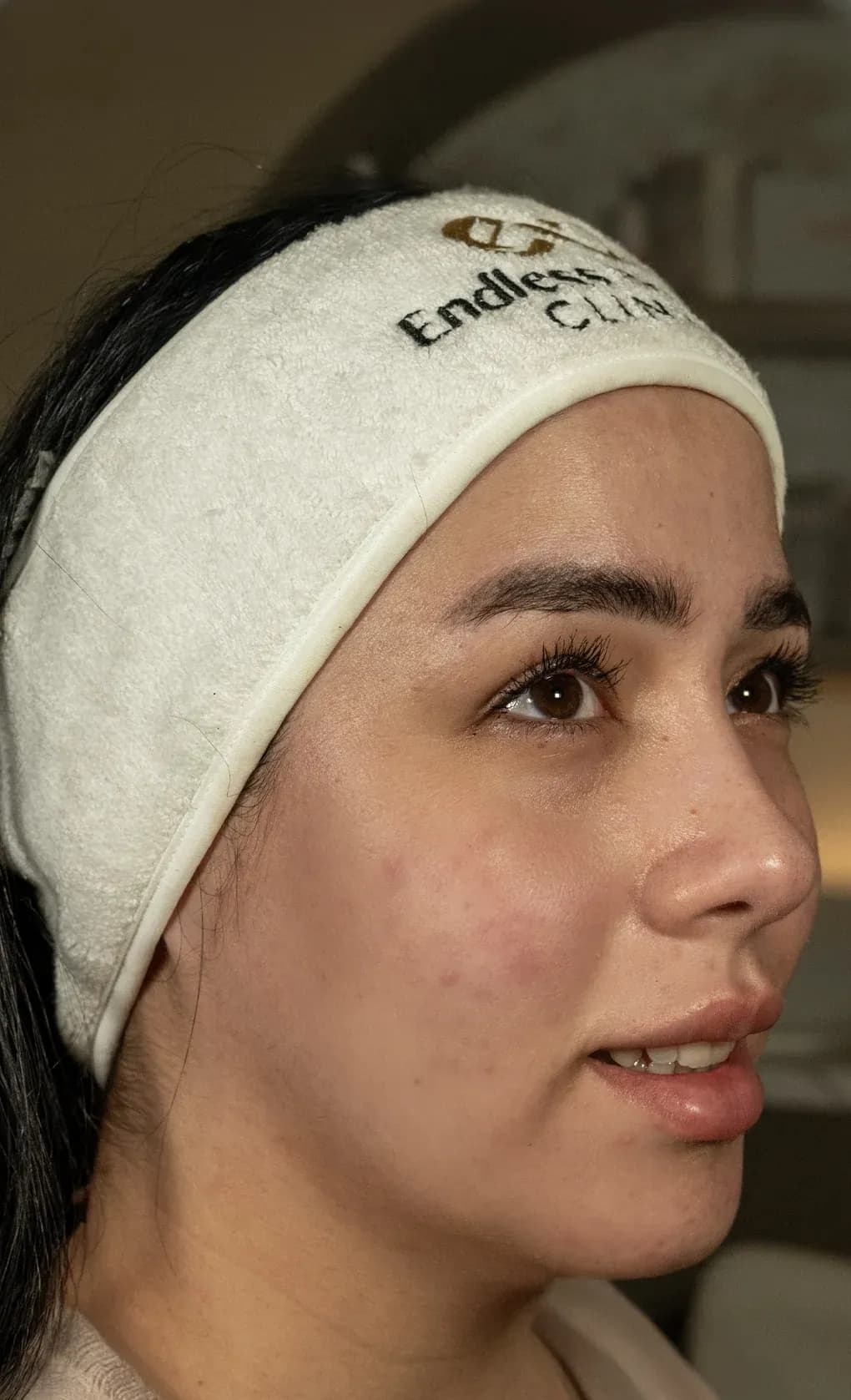 Fotona Facial Lifting Result after treatment
