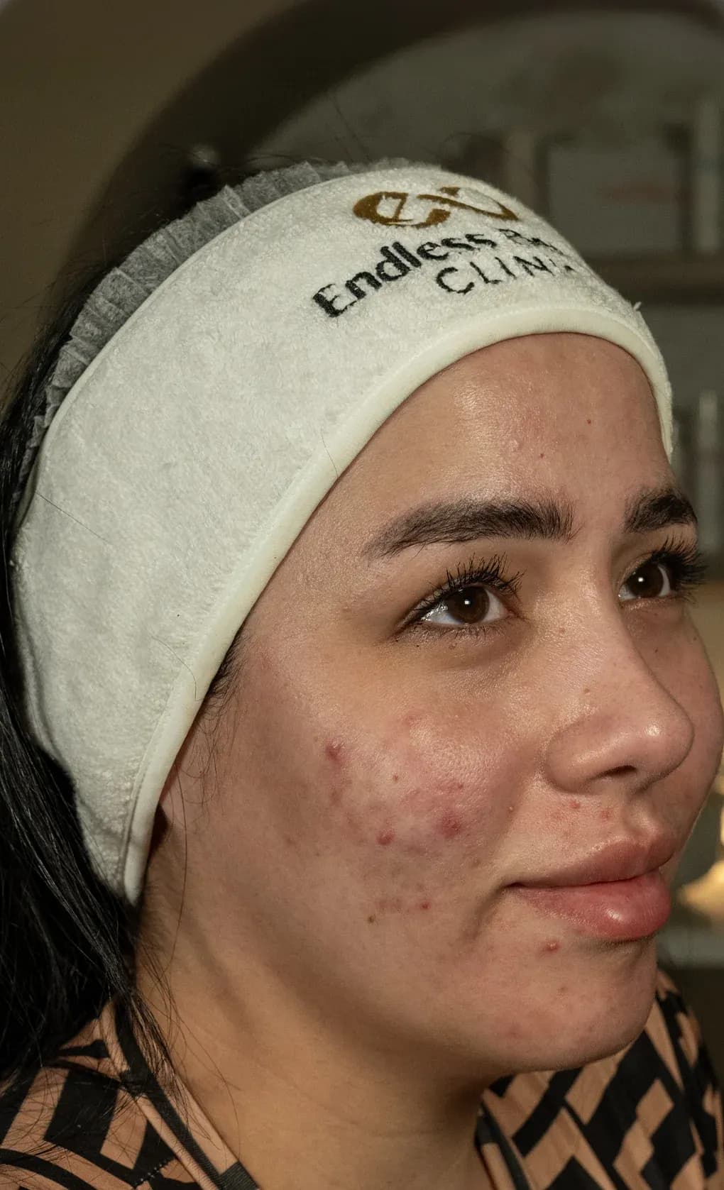 Fotona Facial Lifting Result before treatment