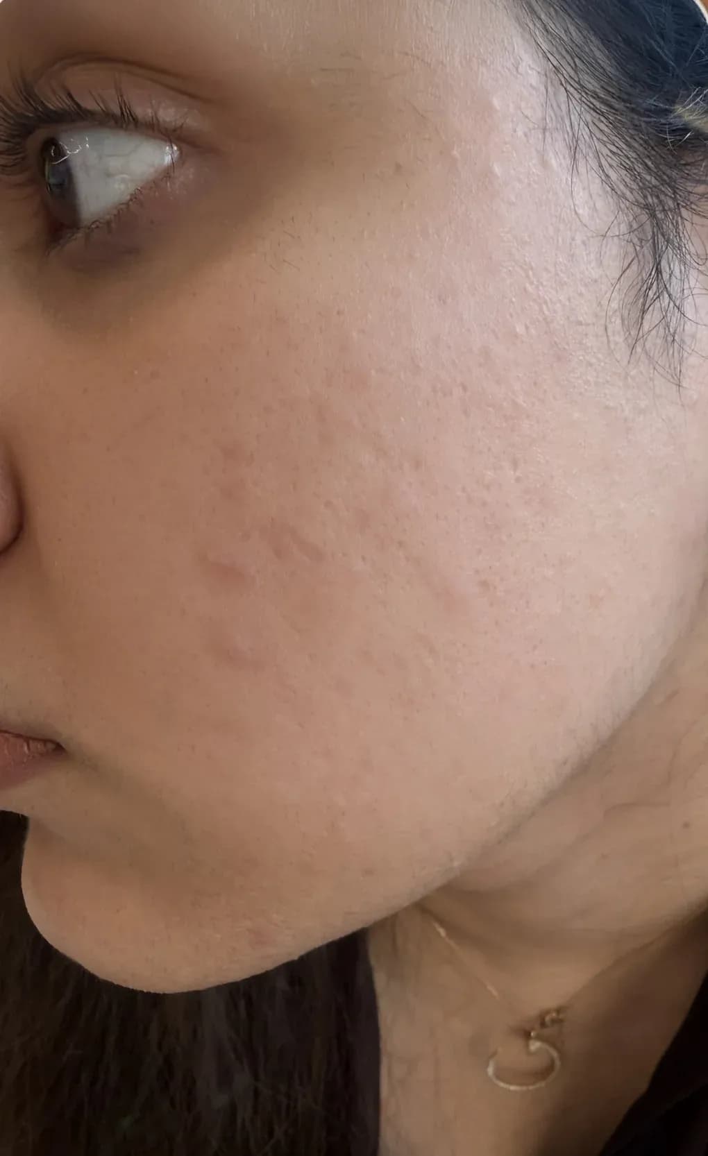 Acne Scar and Texture Refinement after treatment
