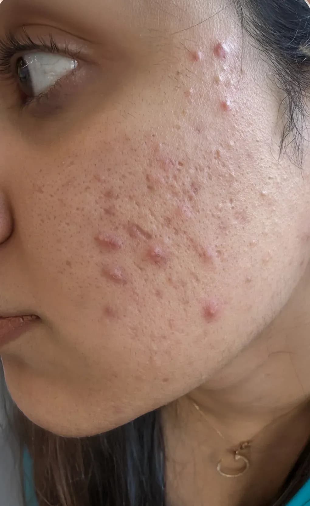 Acne Scar and Texture Refinement before treatment