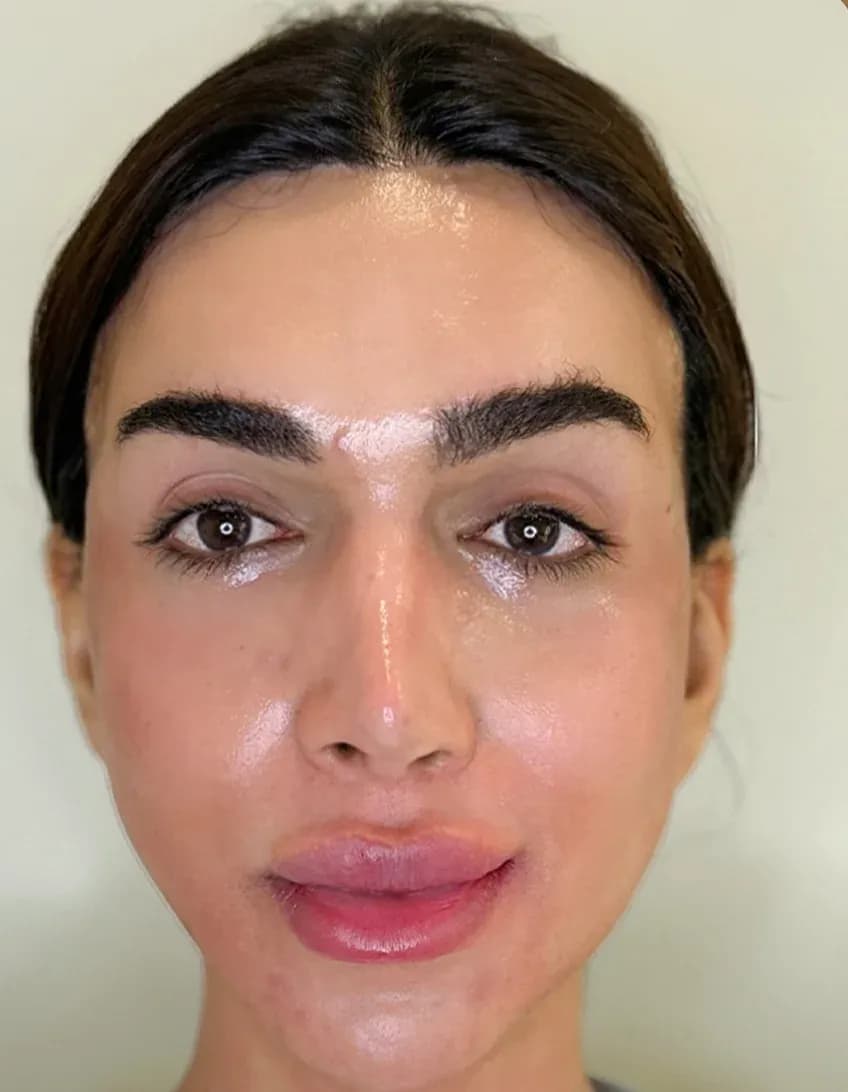 Korean 3D Lift Frontal Result after treatment