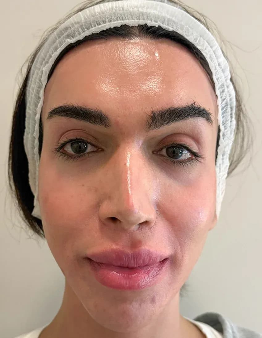 Korean 3D Lift Frontal Result before treatment