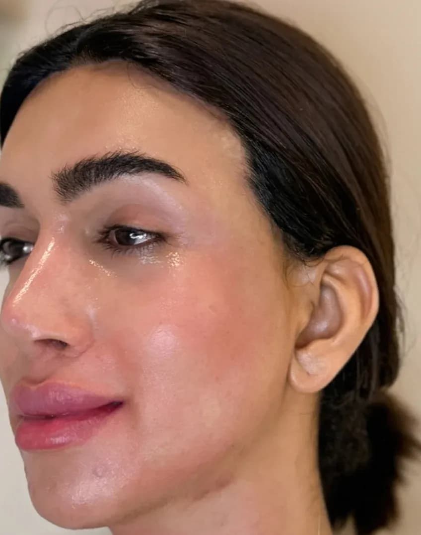 Korean 3D Lift Profile Result after treatment