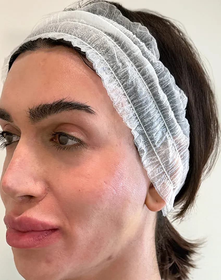 Korean 3D Lift Profile Result before treatment