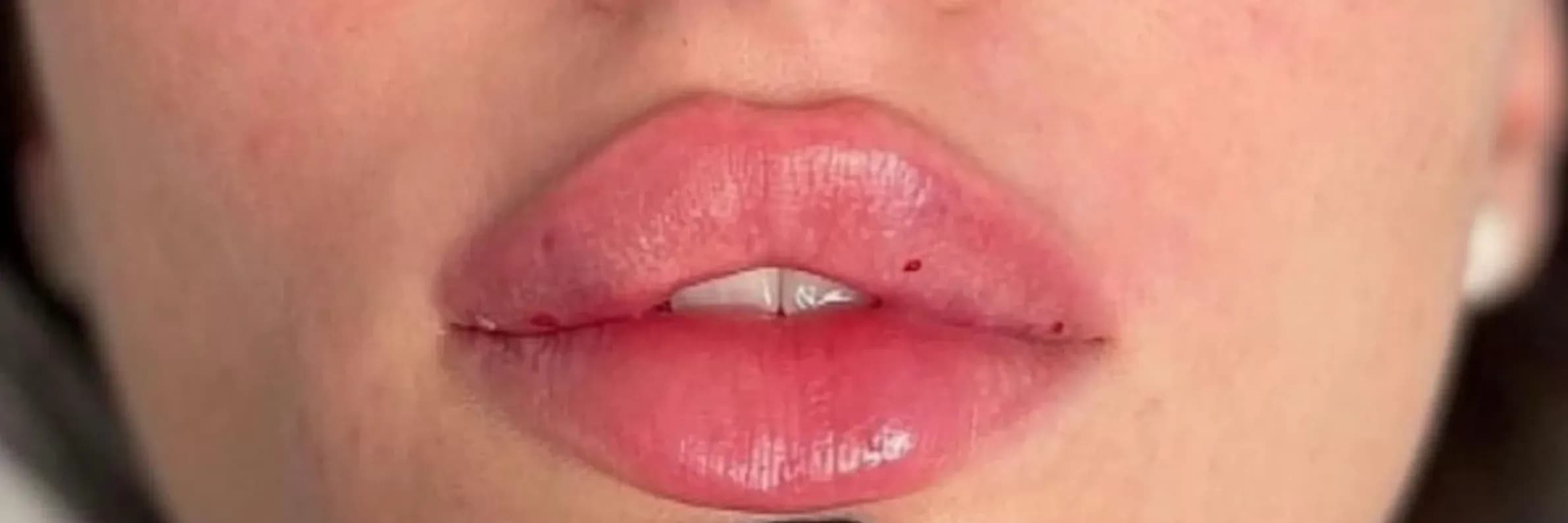 Iconic Lips Enhancement after treatment