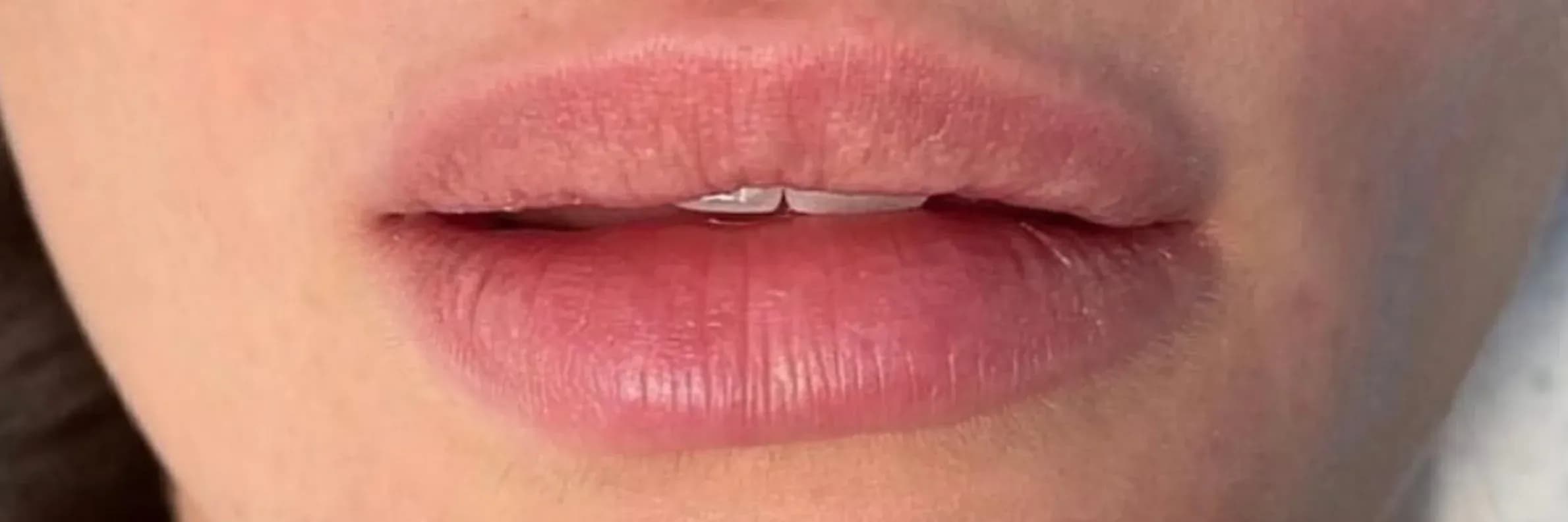 Iconic Lips Enhancement before treatment
