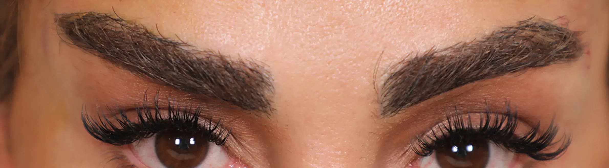 Iconic Eye Area Refinement after treatment