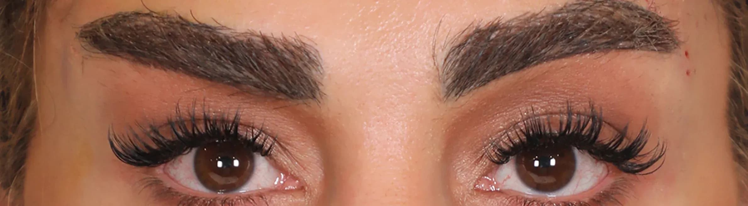 Iconic Eye Area Refinement before treatment