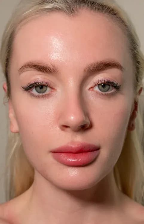 Facial Harmony and Profile Lift after treatment