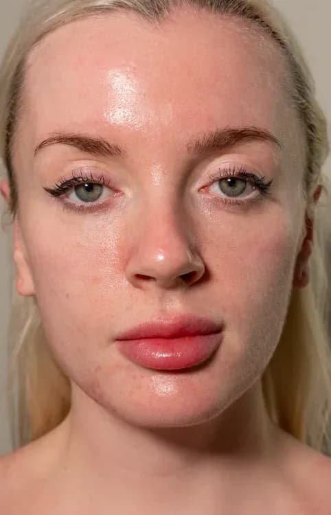 Facial Harmony and Profile Lift before treatment