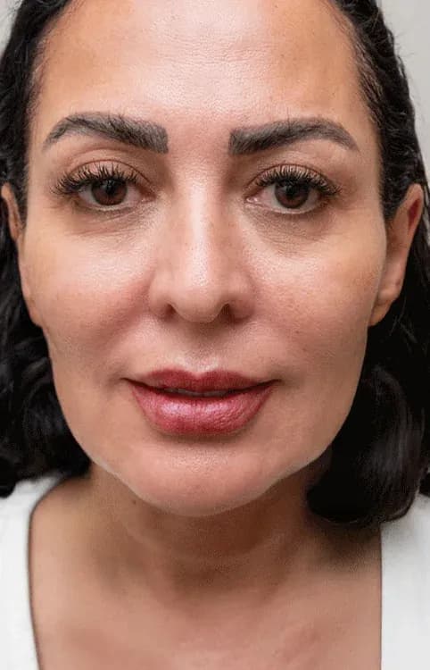Profhilo Skin Quality Result after treatment