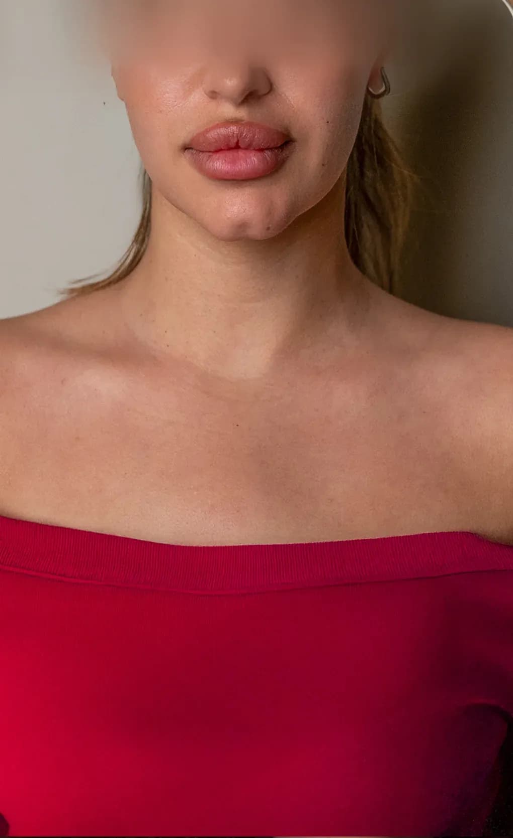 Lip Filler Contour Result after treatment