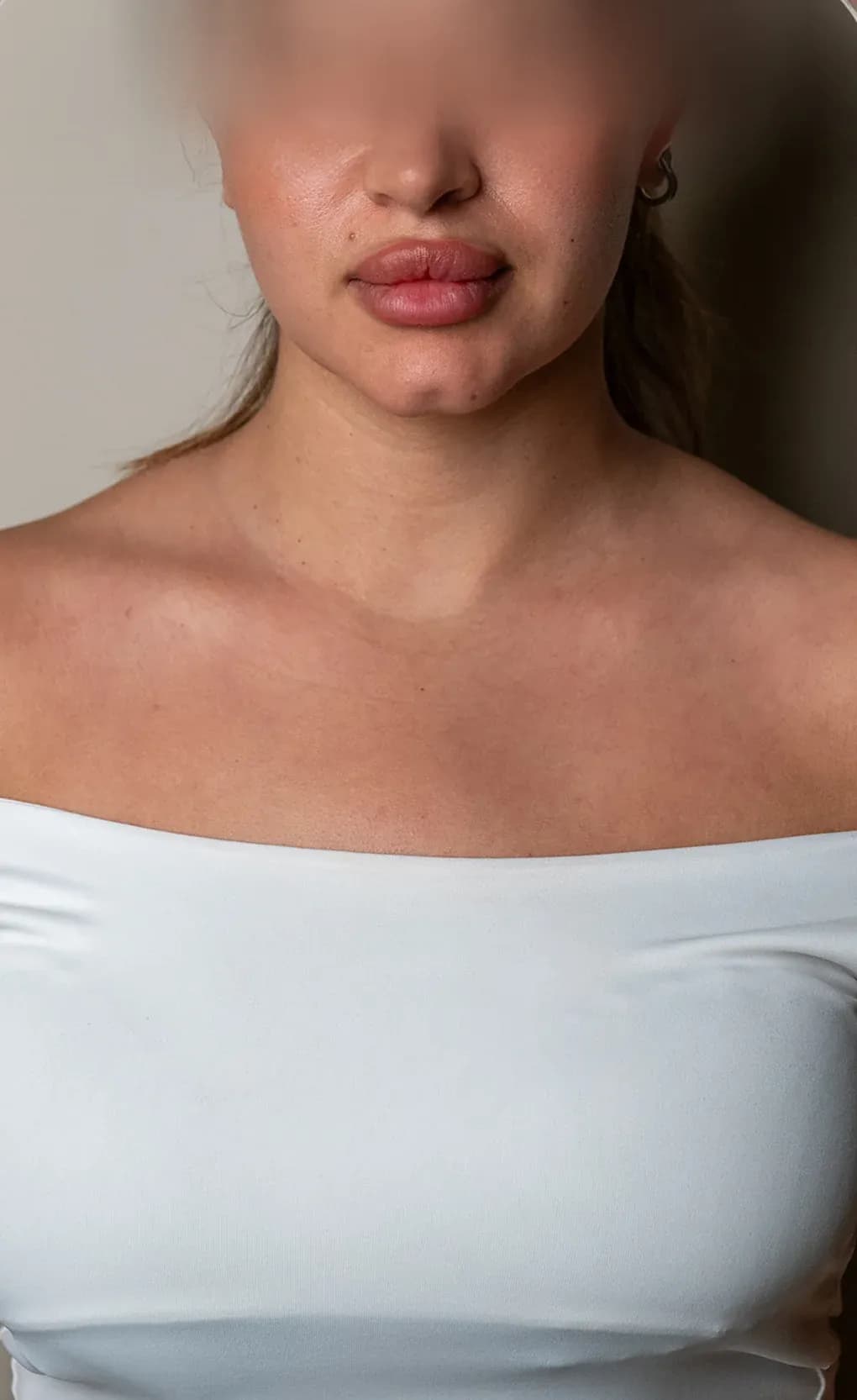 Lip Filler Contour Result before treatment