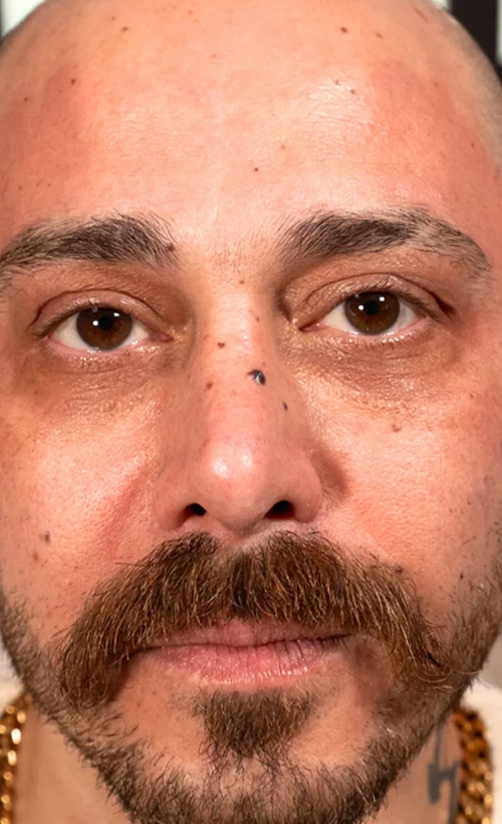 Fotona Lifting Facial Result after treatment