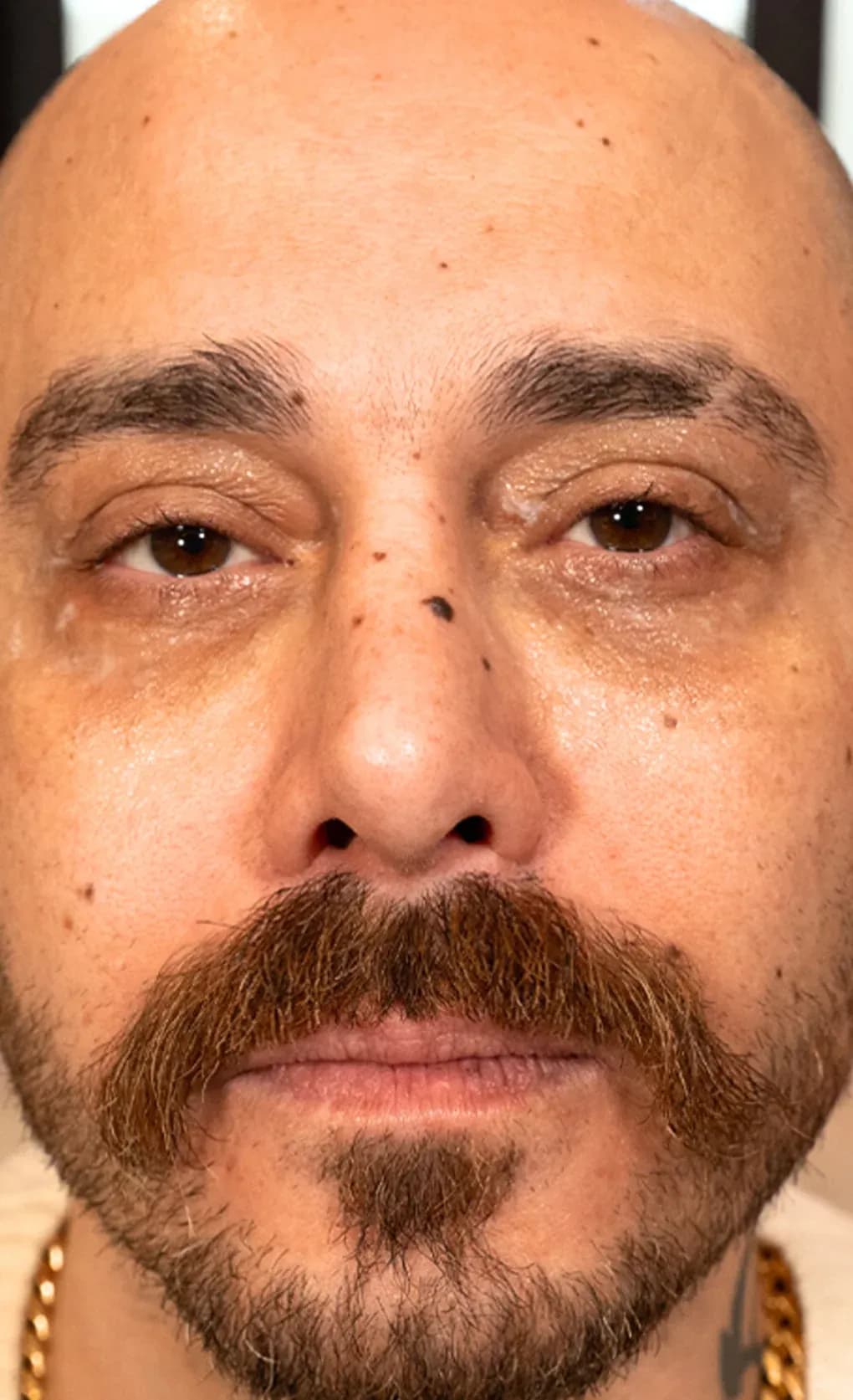 Fotona Lifting Facial Result before treatment