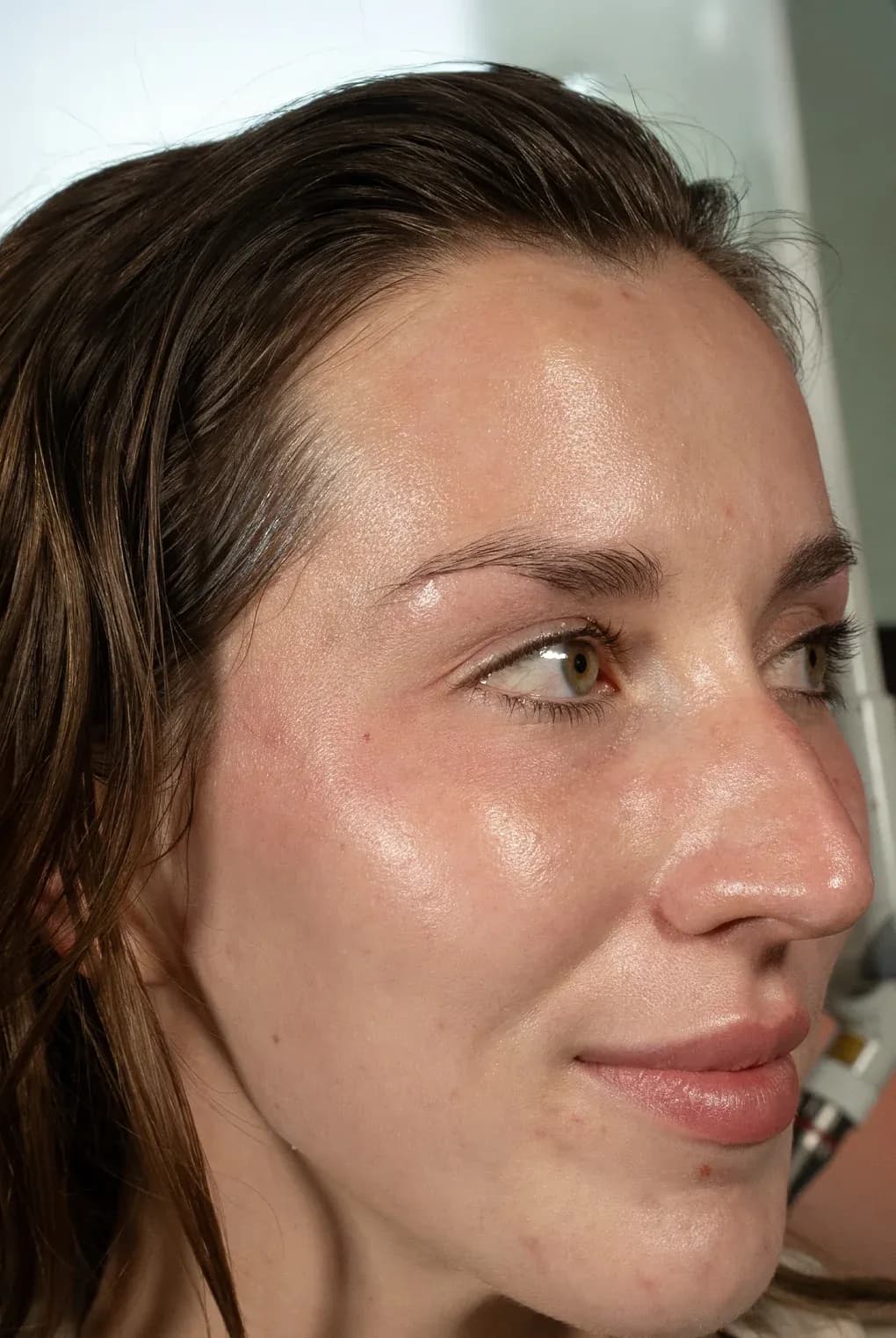 Fotona Face Lifting Profile after treatment