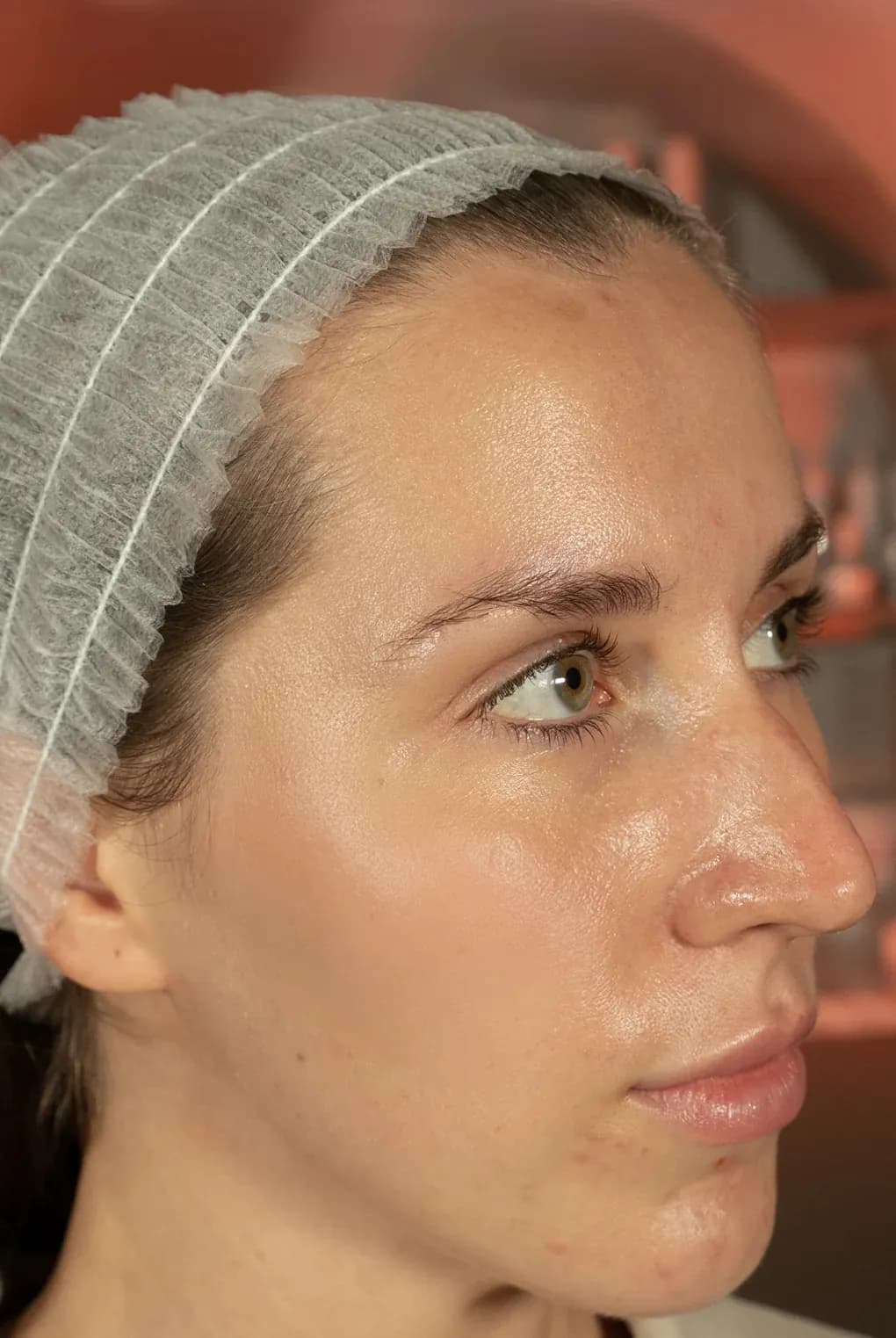 Fotona Face Lifting Profile before treatment