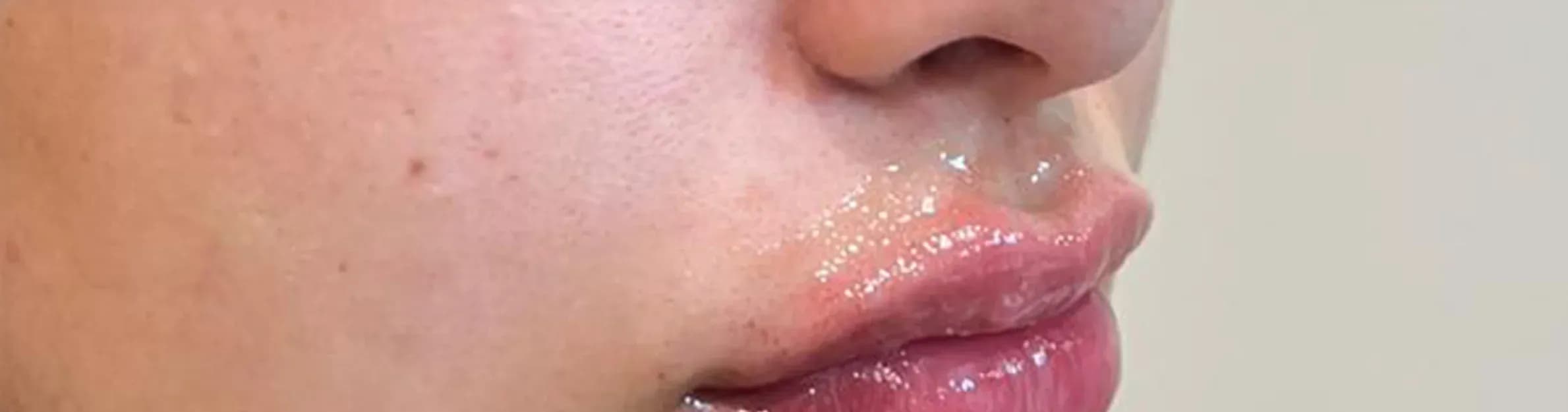 Lip Filler Balance Result after treatment