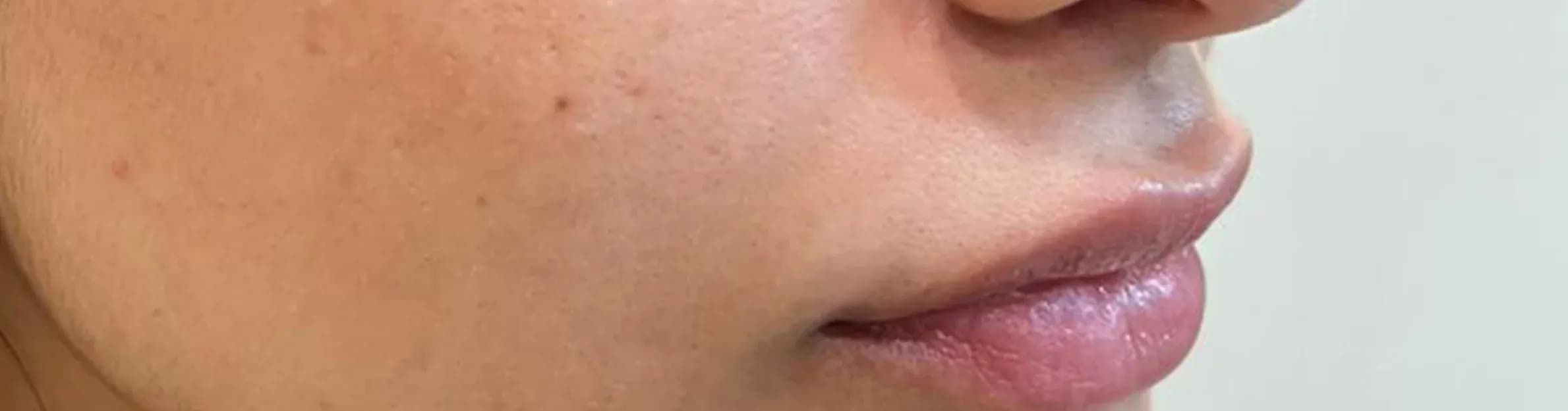 Lip Filler Balance Result before treatment