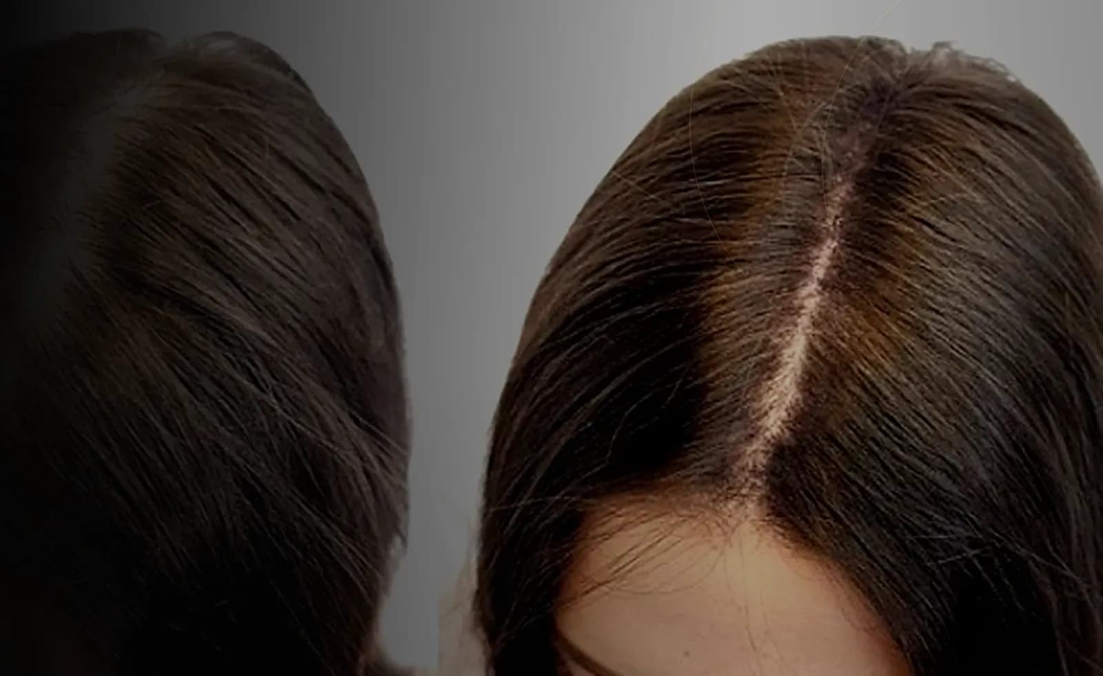 Hair Loss Consultation in Dubai at Endless Beauty Clinic Dubai