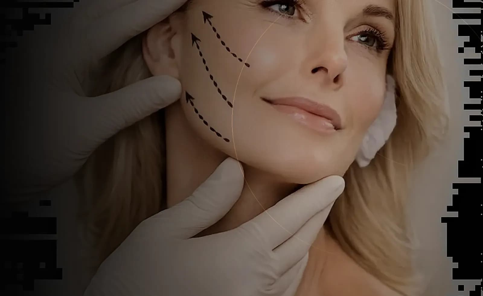 PDO Thread Lift in Dubai at Endless Beauty Clinic Dubai